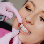 What to Expect During Your Dental Veneers Process