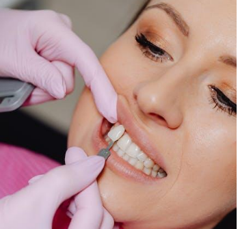 What to Expect During Your Dental Veneers Process